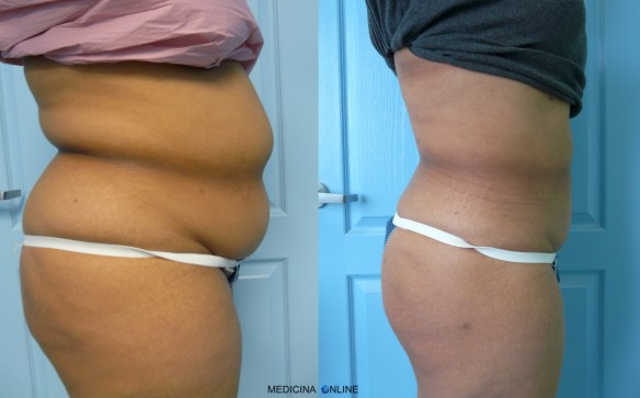 MEDICINA ONLINE CRIOLIPOLISI FREDDO CAVITAZIONI ULTRASUONI RADIOFREQUENZA MEDICINA ESTETICA GRASSO DIMAGRIRE.jpg