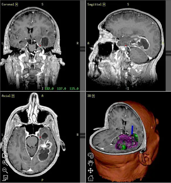 Dott. Loiacono Emilio Alessio Medico Chirurgo Medicina Chirurgia Estetica Benessere Dietologia Sessuologia Ecografie Tabagismo Smettere di fumare AIDS tumore cerebrale più maligno il glioblastoma multiforme