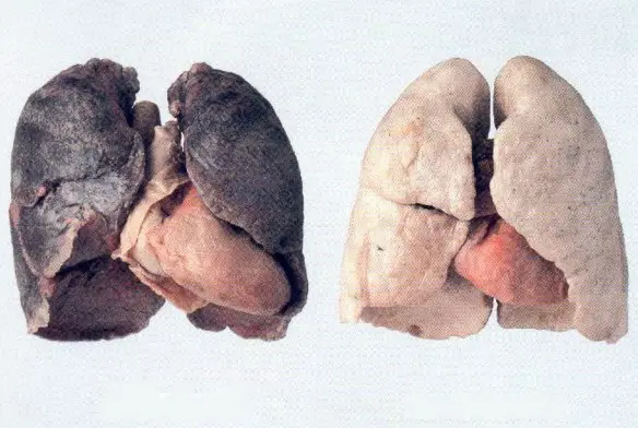 MEDICINA ONLINE FUMARE FUMO SIGARETTE NICOTINA DIPENDENZA DROGA TOSSICODIPENDENZA CANCRO TUMORE POLMONI GRASSO SMETTERE DI FUMARE INGRASSARE CENERE MOZZICONE GIOVANI TABACCO TABAGISMO PIPA SIGARO ELETTRONICA