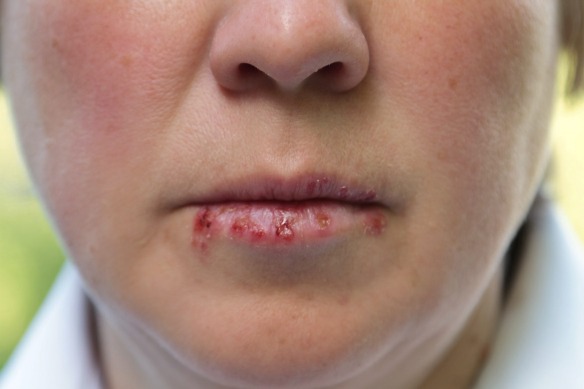 woman's face with a drying herpes on lips