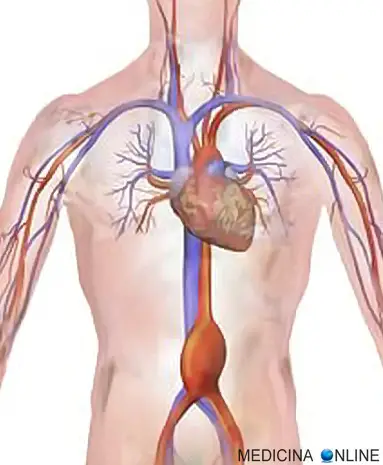 MEDICINA ONLINE aneurisma aorta addominale