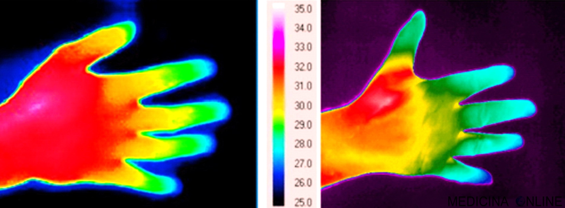 MEDICINA ONLINE FREDDO MANI MANO INVERNO AUTONNO TEMPERATURA GELONI FASTIDIO PIEDI GHIACCIO FREDDISSIMO ESTREMITA CAPILLARI UNGHIE DOLORE SINOSITE RAFFREDDORE FEBBRE INFLUENZA TERMOGRAFIA.jpg