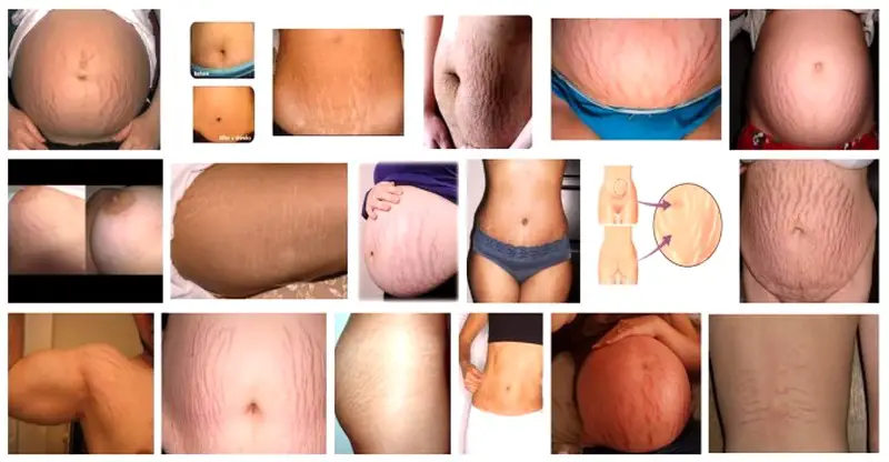 MEDICINA ONLINE SMAGLIATURE PELLE CUTE INESTETISMO DONNA UOMO LASER CAVITAZIONE RADIOFREQUENZA MONOPOLARE DIPOLARE TRIPOLARE MEDICINA ESTETICA COSMETICI.jpg