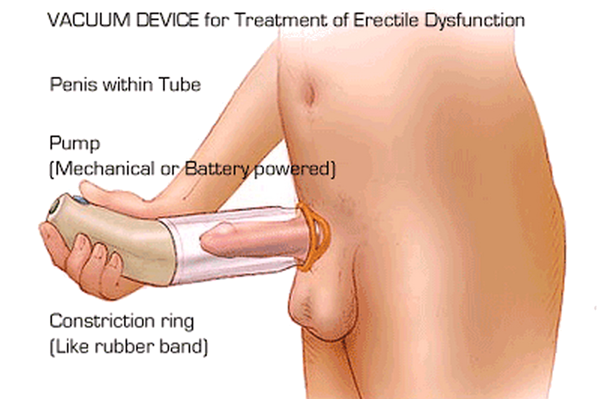 Erectile Dysfunction Porn Video
