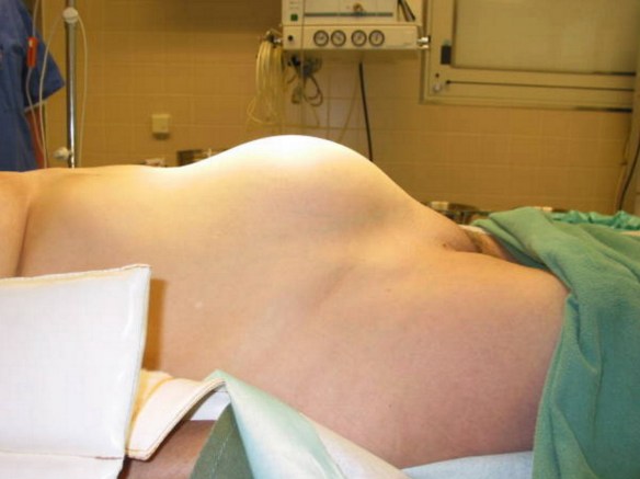 Dott Emilio Alessio Loiacono Medico Chirurgo Flebologo Ecografia Vascolare Articolare CARCINOMA OVAIO SINTOMI Medicina Estetica Luce Pulsata Depilazione Macchie Capillari Mappatura Rughe Dietologo Roma  Radiofrequenza Cavitazione Cellulite Donna HD