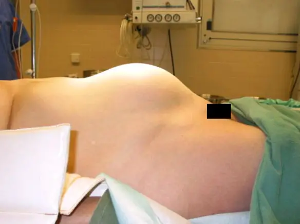 MEDICINA ONLINE EMILIO ALESSIO LOIACONO CARCINOMA OVARICO TUMORE MALIGNO OVAIO MORTALITA PROGNOSI UTERO DONNA CHIRURGIA