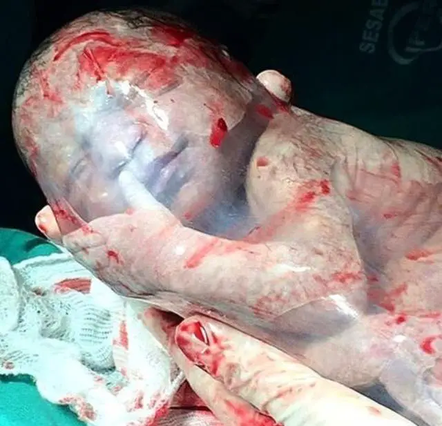 MEDICINA ONLINE Dott Emilio Alessio Loiacono Medico Chirurgo Roma BIMBO NASCE SENZA ROMPERE SACCO AMNIOTICO Riabilitazione Nutrizionista Medicina Estetica Cavitazione Radiofrequenza Ecografia Pulsata  Macchie Capillari Linfodrenaggio Pene.jpg