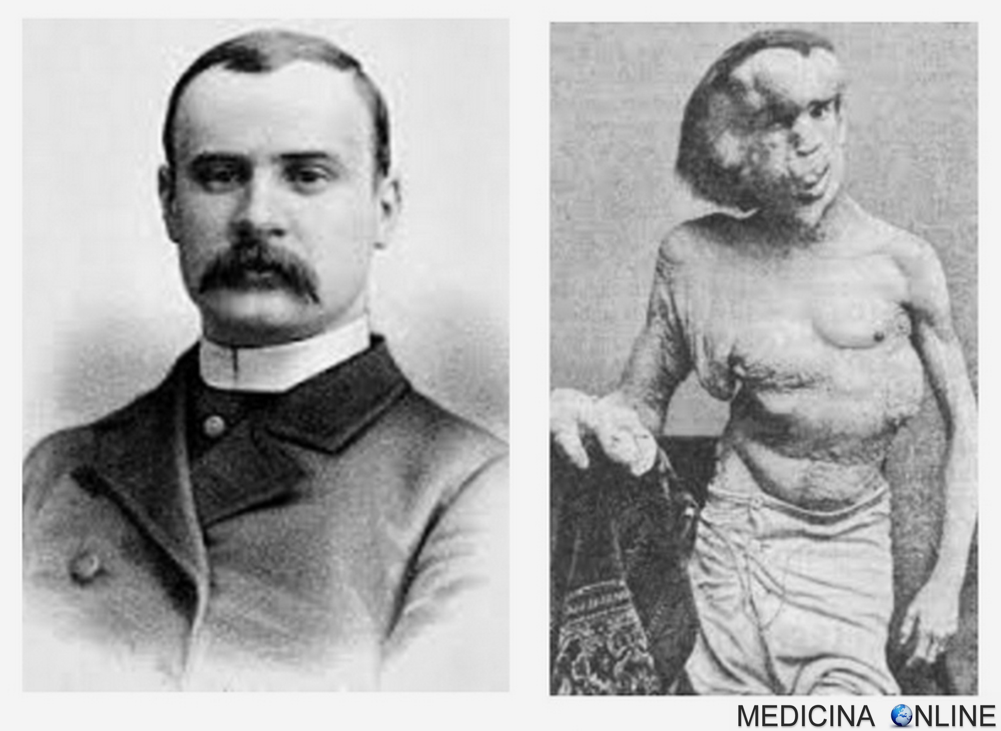 MEDICINA ONLINE FREDERICK TREVES DR JOSEPH MERRICK THE ELEPHANT MAN UOMO ELEFANTE SINDROME DI PROTEO GIGANTISMO GH ACROMEGALIA FROM HELL JACK RIPPER STORIA MALATTIA MORTE STORIA VERA