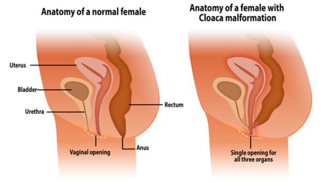 MEDICINA ONLINE MALFORMAZIONE CLOACA RETTO VAGINA UTERO FECONDAZIONE SESSO ANALE SPERMA SPERMATOZOI ANO OVOCELLULA FECONDAZIONE OOCITA.