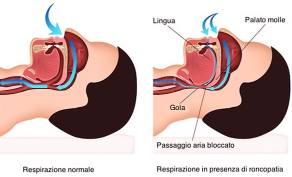 MEDICINA ONLINE Dott Emilio Alessio Loiacono Medico Chirurgo Roma PERCHE SI RUSSA SMETTERE APNEA OSTRUTTIVA SONNO Riabilitazione Nutrizionista Dieta Medicina Estetica Cavitazione Radiofrequenza Ecografia Seno Pulsata Macchie Capillari Pene A