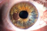 MEDICINA ONLINE Dott Emilio Alessio Loiacono Medico Chirurgo Roma NEO NEVO OCCHIO MELANOMA OCULARE Riabilitazione Nutrizionista Medicina Estetica Cavitazione Radiofrequenza Ecografia Pulsata Macchie Capillari Linfodrenaggio Pene Vagina Ano
