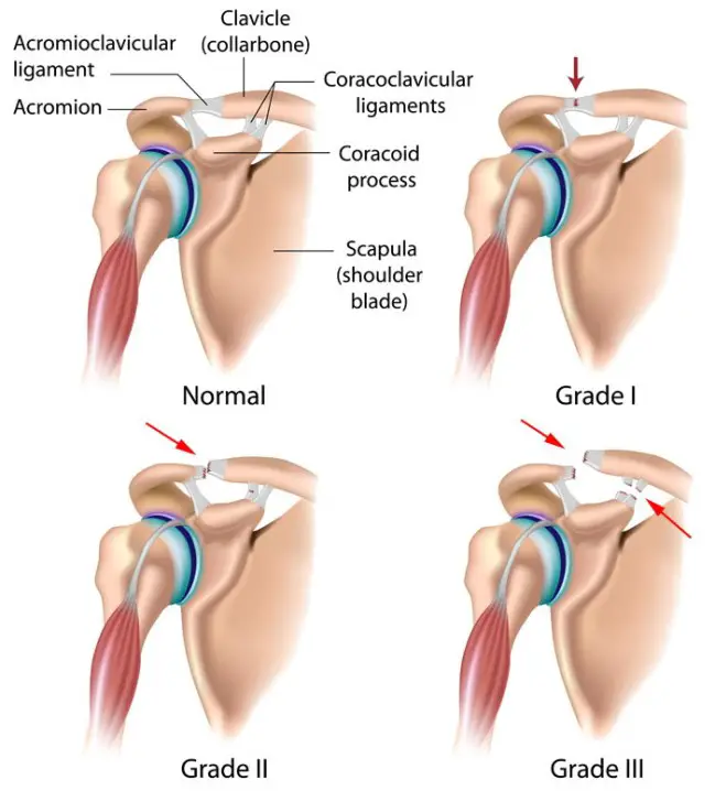 MEDICINA ONLINE Dott Emilio Alessio Loiacono Medico Chirurgo Roma LUSSAZIONE DELLA SPALLA CAUSE COSA FARE  Riabilitazione Nutrizionista Infrarossi Accompagno Commissioni Cavitazione Radiofrequenza Ecografia Pulsata  Macchie Capillari Ano Pene.jpg