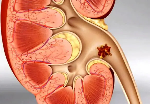 MEDICINA ONLINE Dott Emilio Alessio Loiacono Medico Chirurgo Roma CALCOLI RENALI CIBI VIETATI CONSENTITI  Riabilitazione Nutrizionista Infrarossi Accompagno Commissioni Cavitazione Radiofrequenza Ecografia Pulsata  Macchie Capillari Ano Pene.jpg