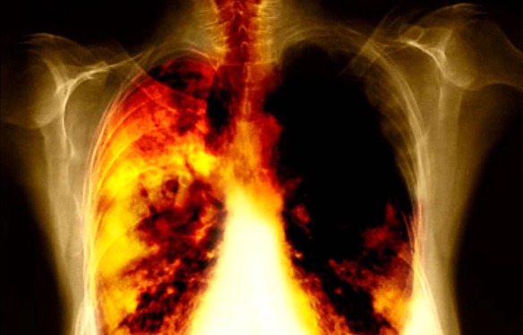 MEDICINA ONLINE POLMONI TUMORE SIGARETTA NICOTINA TABAGISMO CANCRO METASTASI FUMARE