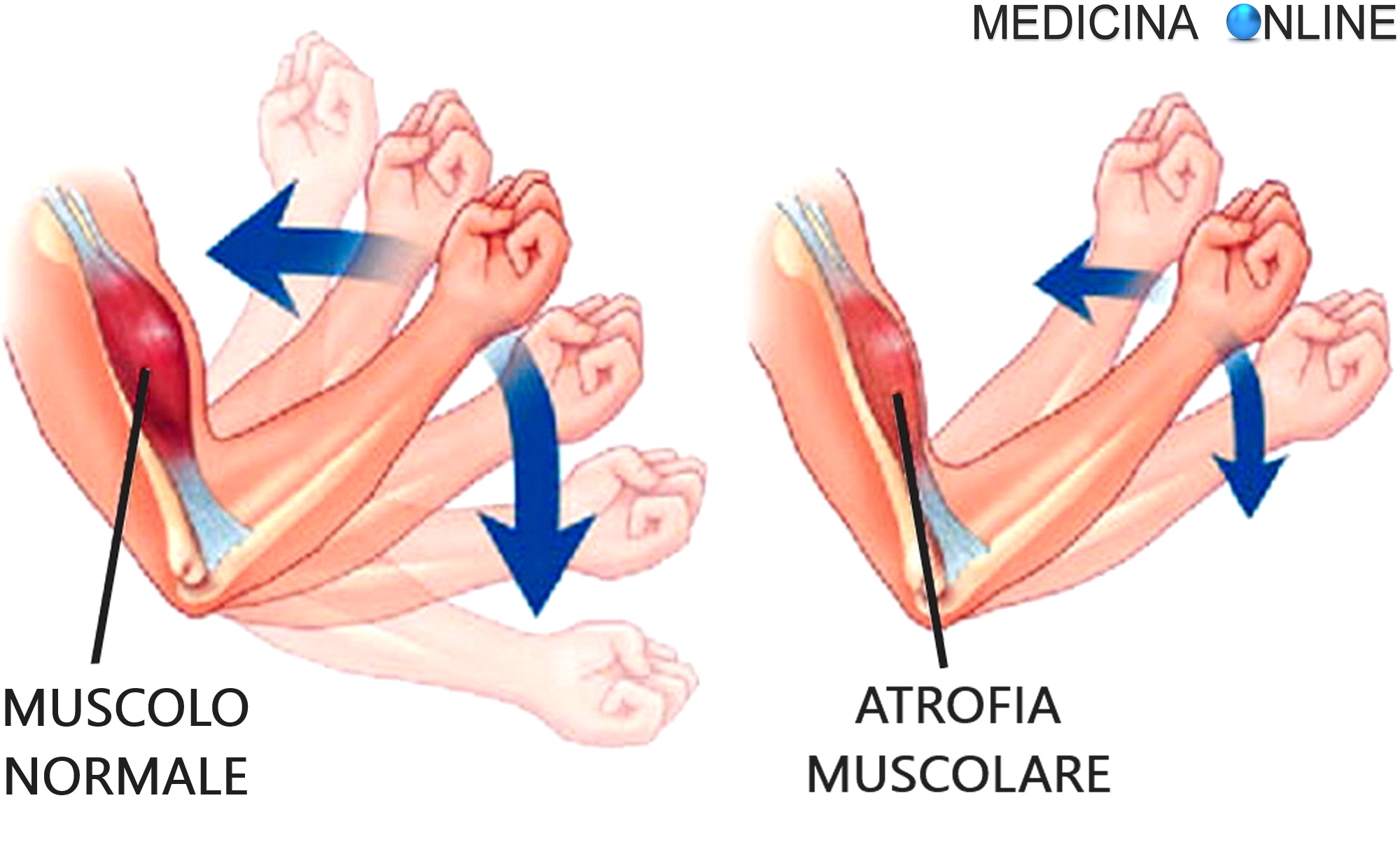 MEDICINA ONLINE EMILIO ALESSIO LOIACONO MEDICO CHIRURGO DEBOLEZZA AL BRACCIO O ALLE BRACCIA QUALI CAUSE SINTOMI ASSOCIATI BICIPITE TRICIPITE ATROFIA MUSCOLO FRATTURA LEGAMENTO TENDINE OSSA COSA FARE ICTUS INFARTO DOLORE