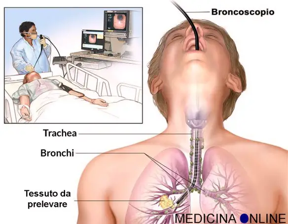 MEDICINA ONLINE Dott Emilio Alessio Loiacono Medico Chirurgo Roma BRONCOSCOPIA POLMONARE BIOPSIA FA MALE  Riabilitazione Nutrizionista Infrarossi Accompagno Commissioni Cavitazione Radiofrequenza Ecografia Pulsata  Macchie Capillari Ano Pene.jpg