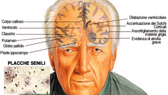 MEDICINA ONLINE Dott Emilio Alessio Loiacono Medico Chirurgo Roma DEMENZA SENILE CAUSE DECORSO SINTOMI Riabilitazione Nutrizionista Infrarossi Accompagno Commissioni Cavitazione Radiofrequenza Ecografia Pulsata Macchie Capillari Ano Pene.jpg