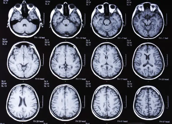 MEDICINA ONLINE Dott Emilio Alessio Loiacono Medico Chirurgo Roma DIAGNOSI DIFFERENZIALE MORBO PARKINSON Riabilitazione Nutrizionista Infrarossi Accompagno Commissioni Cavitazione Radiofrequenza Ecografia Pulsata  Macchie Capillari Ano Pene.jpg