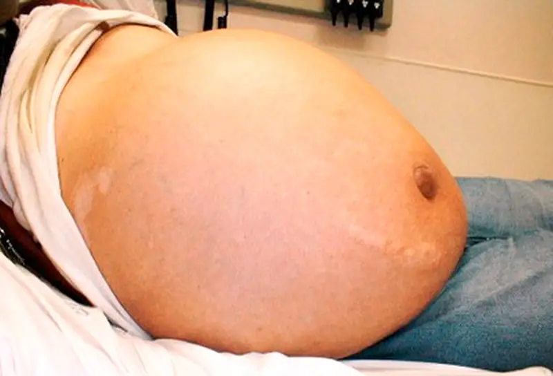 MEDICINA ONLINE Dott Emilio Alessio Loiacono Medico Chirurgo Roma IDROPISIA ANASARCA EDEMA GENERALE Riabilitazione Nutrizionista Infrarossi Accompagno Commissioni Cavitazione Radiofrequenza Ecografia Pulsata  Macchie Capillari Ano Pene.jpg