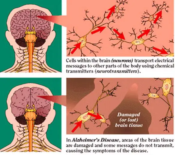 MEDICINA ONLINE Dott Emilio Alessio Loiacono Medico Chirurgo Roma MORBO ALZHEIMER FARMACI CAUSE MALATTIA Riabilitazione Nutrizionista Infrarossi Accompagno Commissioni Cavitazione Radiofrequenza Ecografia Pulsata  Macchie Capillari Ano Pene.jpg