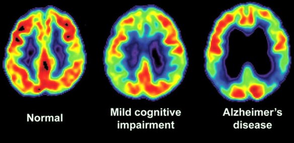 MEDICINA ONLINE Dott Emilio Alessio Loiacono Medico Chirurgo Roma MORBO ALZHEIMER SCREENING DIAGNOSI INIZI Riabilitazione Nutrizionista Infrarossi Accompagno Commissioni Cavitazione Radiofrequenza Ecografia Pulsata  Macchie Capillari Ano Pene.jpg