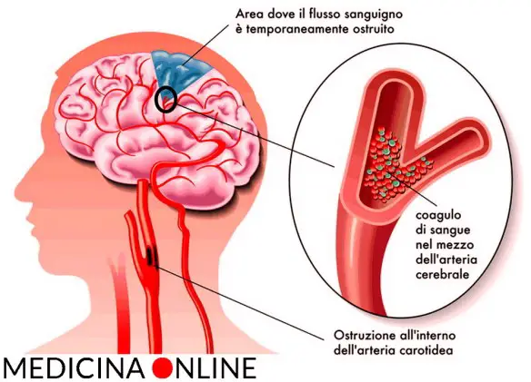 MEDICINA ONLINE Dott Emilio Alessio Loiacono Medico Chirurgo Roma perche ostruzione carotide pericolosa Riabilitazione Nutrizionista Infrarossi Accompagno Commissioni Cavitazione Radiofrequenza Ecografia Pulsata  Macchie Capillari Ano Pene.jpg