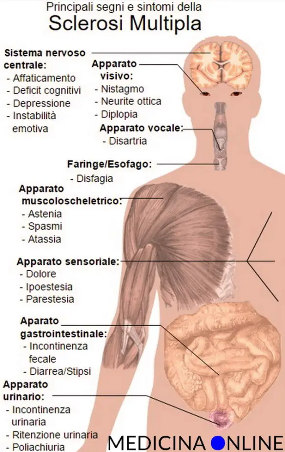 MEDICINA ONLINE Dott Emilio Alessio Loiacono Medico Chirurgo Roma SCLEROSI MULTIPLA CAUSE MORTE SINTOMI Riabilitazione Nutrizionista Infrarossi Accompagno Commissioni Cavitazione Radiofrequenza Ecografia Pulsata Macchie Capillari Ano Pene