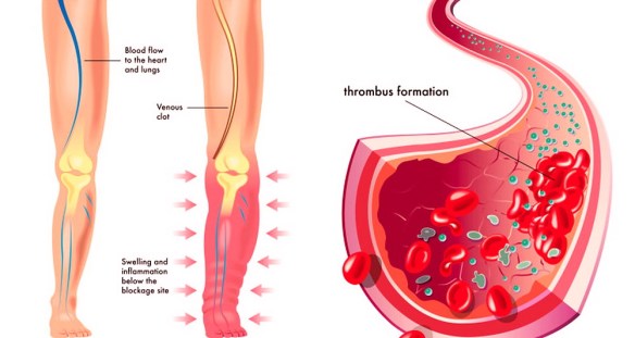 MEDICINA ONLINE DIFFERENZA ATEROSCLEROSI ARTERIOSCLEROSI PLACCA EMBOLO EMBOLIA TROMBOSI INFARTO CUORE SANGUE CIRCOLAZIONE SANGUIGNA TROMBO