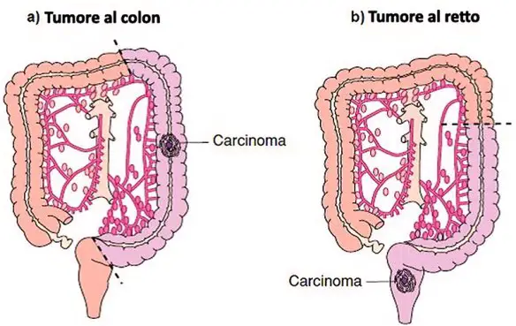 MEDICINA ONLINE TUMORE COLON RETTO ANO TRATTAMENTO CHIRURGICO INTESTINO RADIOTERAPIA CHEMIOTERAPIA CANCRO AMPUTAZIONE.jpg