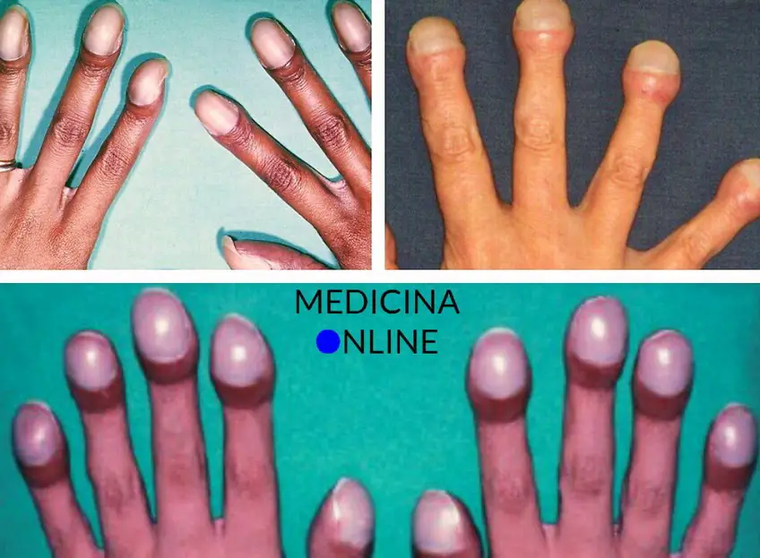 MEDICINA ONLINE Dott Emilio Alessio Loiacono Medico Chirurgo Roma DITA IPPOCRATICHE BACCHETTA TAMBURO DIGITALE Riabilitazione Nutrizionista Infrarossi Accompagno Commissioni Cavitazione Radiofrequenza Ecografia Pulsata Macchie Capillari Ano