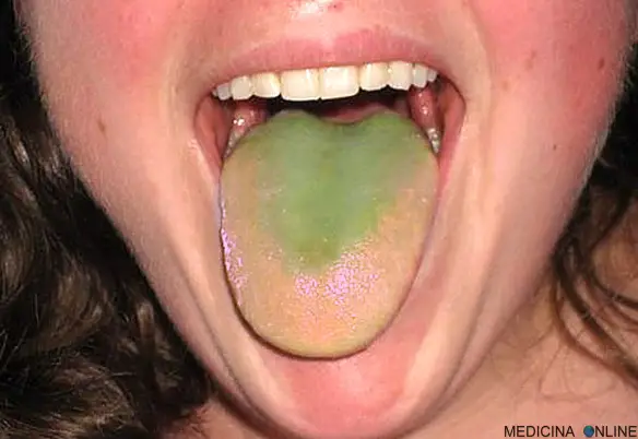 MEDICINA ONLINE EMILIO ALESSIO LOIACONO LINGUA VERDE CAUSE CURE BOCCA DENTI LABBRA SEMEIOTICA
