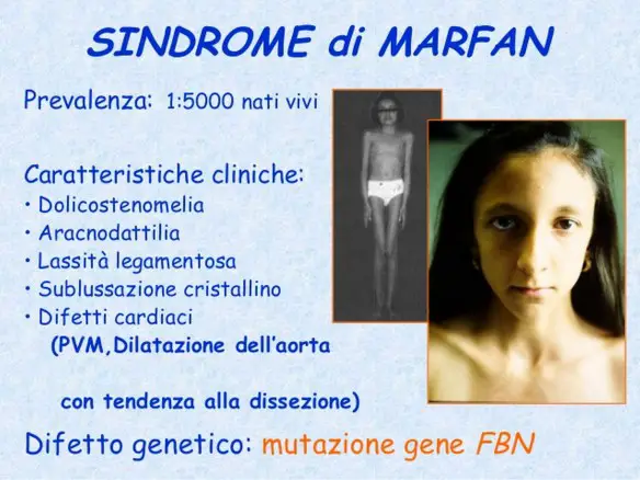 MEDICINA ONLINE SINDROME DI MARFAN GENETICA VITA MORTE PROGNOSI SEGNI CLINICI CARATTERISTICHE