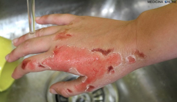MEDICINA ONLINE USTIONE PELLE MANO PRIMO SECONDO TERZO GRADO ACQUA BOLLENTE FUOCO..jpg