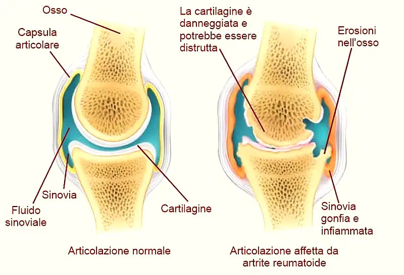 Differenza tra artrite ed artrosi: come riconoscerle | MEDICINA ONLINE