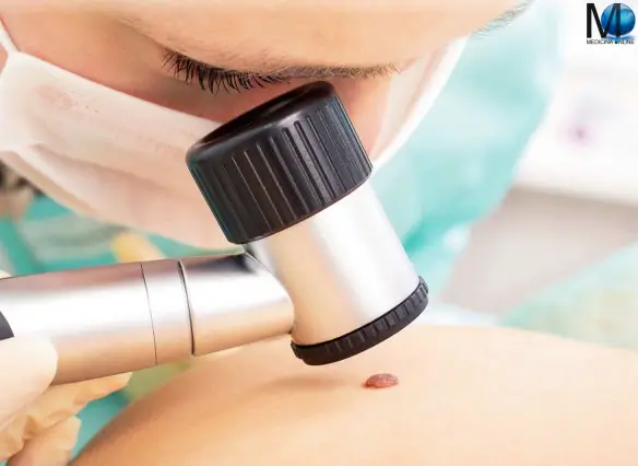 MEDICINA ONLINE DERMATOSCOPIA IN EPILUMINESCENZA MAPPATURA DEI NEI MAP DERMATOSCOPY SKIN PELLE CUTE NEO NEVO NEI NEVI DISPLASTICI CANCRO CANCEROSI TUMORE CARATTERISTICHE FORMA COLORE RILEVATO DIAGNOSI MELANOMA MORTE GRAVE.jpg