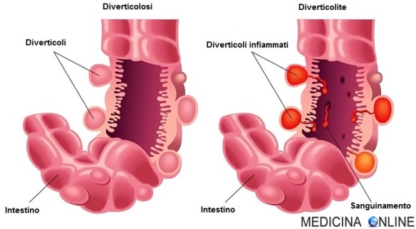 MEDICINA ONLINE DIVERTICOLI DIVERTICOLITE DIVERTICOLOSI COLON COLITE SINTOMI DIFFERENZE INTESTINO DIGERENTE.jpg