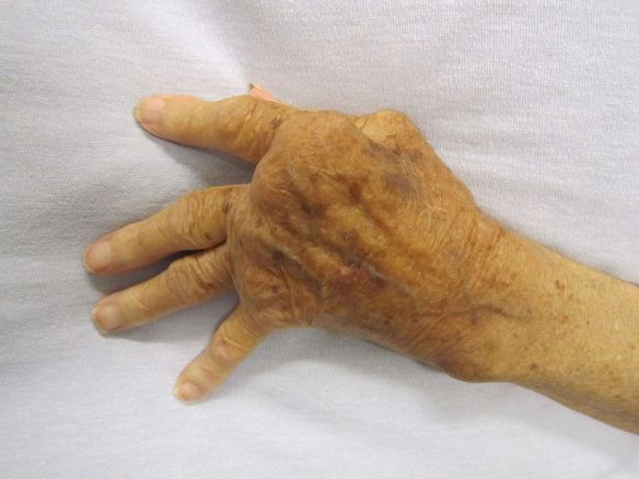MEDICINA ONLINE Dott Emilio Alessio Loiacono Medico Chirurgo Roma DIFFERENZE ARTRITE ARTOSI SINTOMI COMUNI Riabilitazione Nutrizionista Infrarossi Accompagno Commissioni Cavitazione Radiofrequenza Ecografia Pulsata Macchie Capillari Ano Pene.JPG