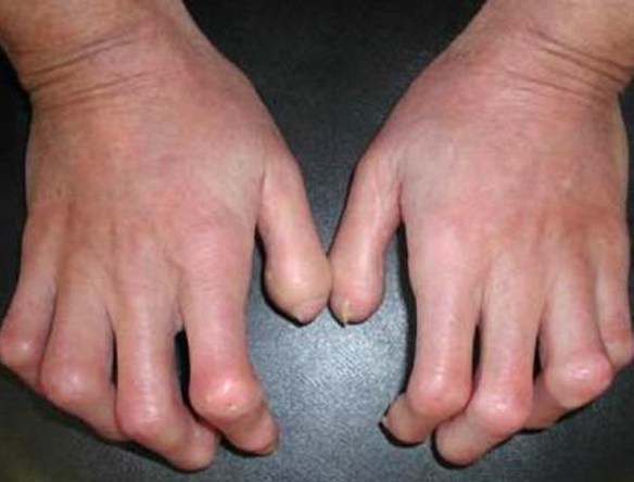 MEDICINA ONLINE Dott Emilio Alessio Loiacono Medico Chirurgo Roma SCLERODERMIA CAUSE SINTOMI CURE Riabilitazione Nutrizionista Infrarossi Accompagno Commissioni Cavitazione Radiofrequenza Ecografia Pulsata  Macchie Capillari Ano Pene.jpg