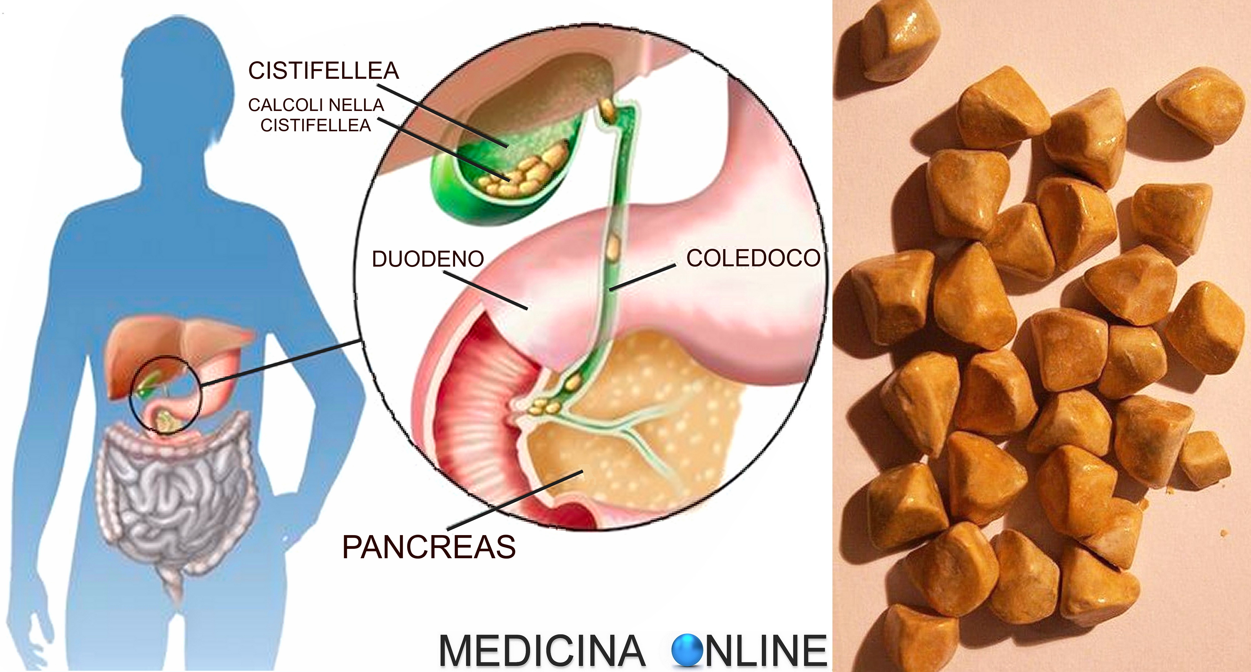 MEDICINA ONLINE EMILIO ALESSIO LOIACONO MEDICO CHIRURGO COLICA BILIARE BILE CISTIFELLEA DOTTO CISTICO EPATICO COMUNE COLEDOCO CALCOLOSI DELLA COLECISTI FEGATO LITIASI COLELITIASI CALCOLI BILIARI RIMEDI