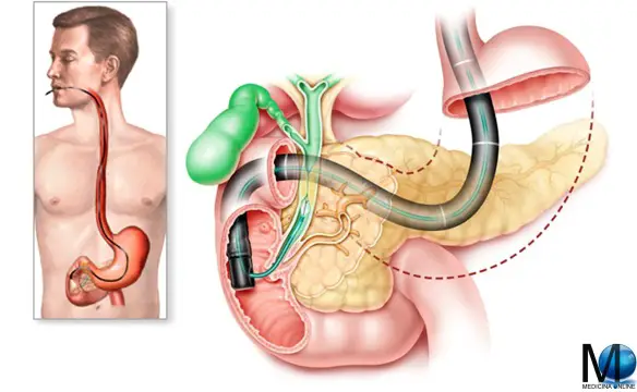 MEDICINA ONLINE ESOFAGO STOMACO DUODENO INTESTINO TENUE DIGIUNO ILEO SCOPIA APPARATO DIGERENTE CIBO DIGESTIONE TUMORE CANCRO POLIPO ULCERA DIVERTICOLO CRASSO FECI SANGUE OCCULTO MILZA VARICI CIRROSI EPATICA FEGATO ERCP