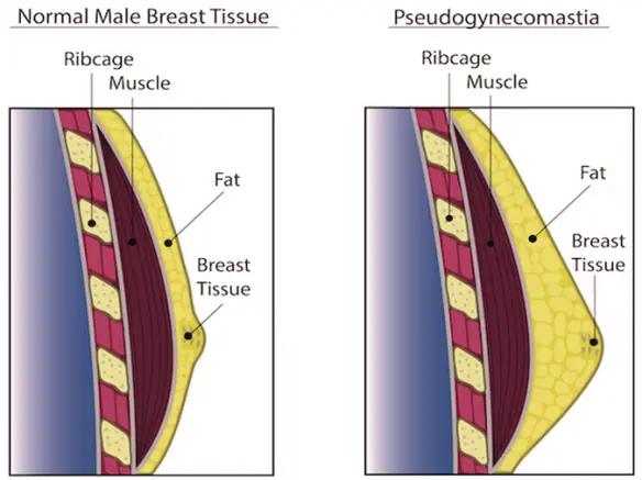 MEDICINA ONLINE GINECOMASTIA VERA FALSA PSEUDOGINECOMASTIA ACQUISITA PUBERALE CONGENITA DIFFERENZA GRASSO TESSUTO ADIPOSO GHIANDOLA MAMMARIA COMPONENTE GHIANDOLARE ECOGRAFIA DIAGNOSI CURE CHIRURGIA BODY BUILDING STEROIDI.png