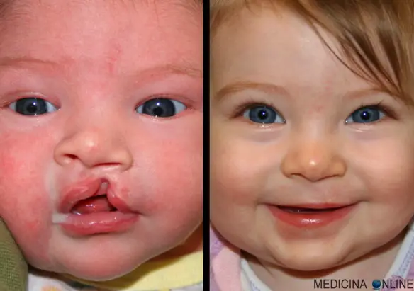 MEDICINA ONLINE LINGUA BOCCA FRENULO ANATOMIA FISIOLOGIA ORAL TONGUE LABIOSCHISI LABBRA LEPORINO GENGIVE DENTI MANDIBOLA MASCELLA PAPILLE GUSTATIVE GUSTO CIBO FONAZIONE GLOSSODINIA PALATO SCHISI.jpg