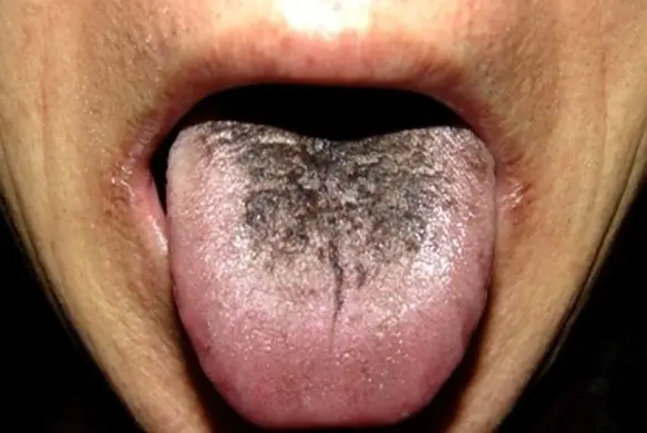 MEDICINA ONLINE LINGUA NERA VILLOSA CAUSE DIAGNOSI TERAPIE BLACK TONGUE.jpg