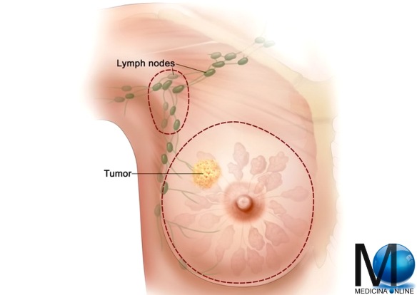 MEDICINA ONLINE PETTO MAMMELLA FORMICOLIO CIRCOLAZIONE CANCRO TUMORE DONNA MORTALITA MORTE PROGNOSI CANCRO TUMORE SENO LINFATICI METASTASI LINFONODO SENTINELLA CARCINOMA DOTTI DUTTALE