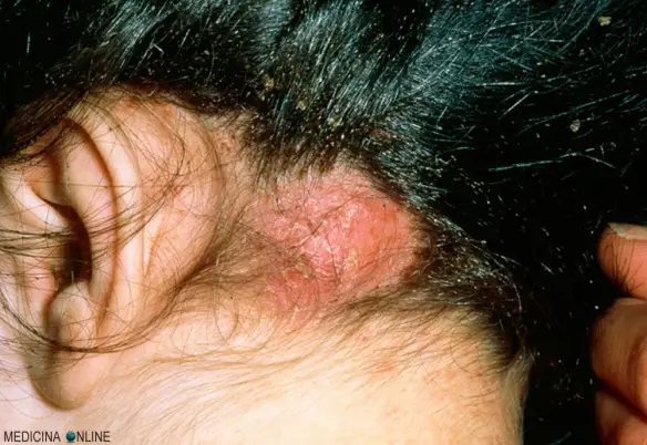 MEDICINA ONLINE PIDOCCHIO TESTA CAPELLI PEDICULOSI PEDICULUS HUMANUS CAPITIS DEL CAPO PTHIRUS PUBIS PIATTOLA CORPORIS CORPO PELLE PARASSITA.jpg