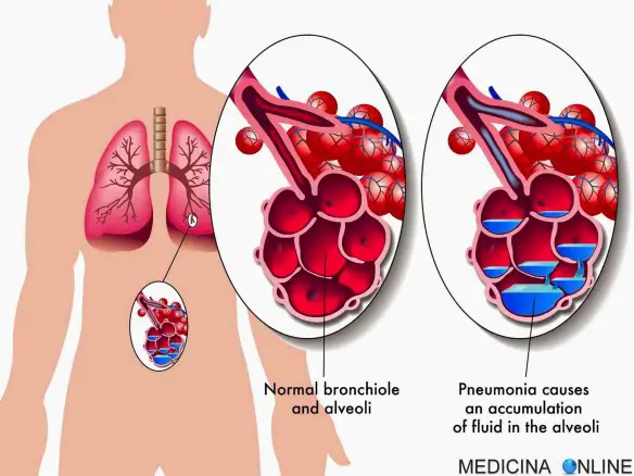MEDICINA ONLINE POLMONITE POLMONI LIQUIDO ALVEOLI