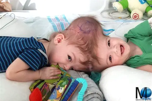 MEDICINA ONLINE SIAMESE TWINS 18 novembre 2016 i gemelli Anias and Jadon McDonald (di 13 mesi) vengono separati al Montefiore Medical Center nel Bronx.
