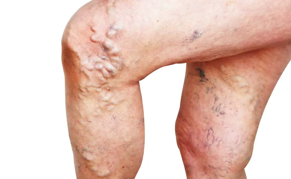 MEDICINA ONLINE VENE VARICOSE VENA ARTERIA CATTIVA CIRCOLAZIONE GAMBA GAMBE PIEDI DOLORE RITENZIONE SANGUE CUORE INSUFFICIENZA VALVOLE