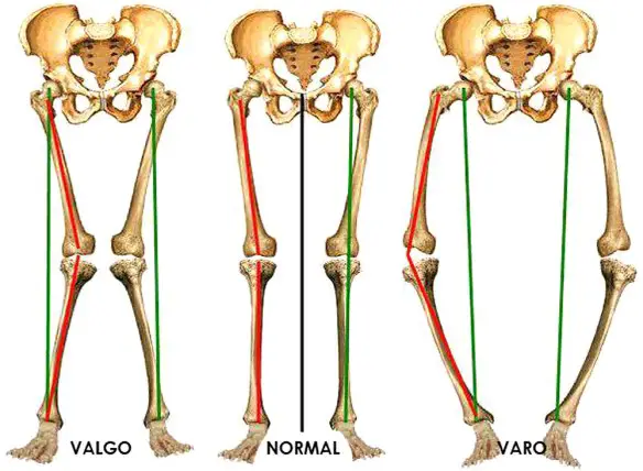MEDICINA ONLINE VARO VALGO GINOCCHIO NORMALE DIFFERENZA GAMBE STORTE VALGISMO FOTO IMMAGINI.jpg