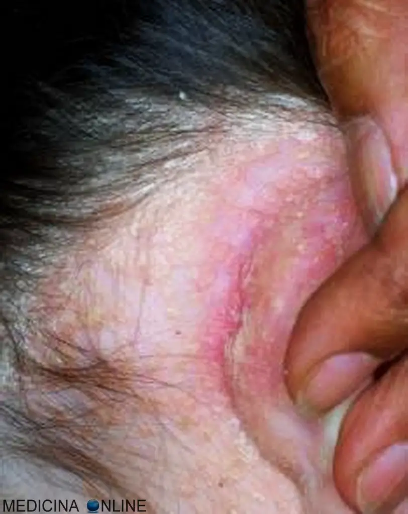 MEDICINA ONLINE DERMATITE SEBORROICA IMMAGINI NUCA CUOIO CAPELLUTO CAPELLI UOMO DONNA FINASTERIDE ALOPECIA AREATA O ANDROGENETICA DIFFERENZE CALVIZIE PELO CAPELLO RASATO DECORSO